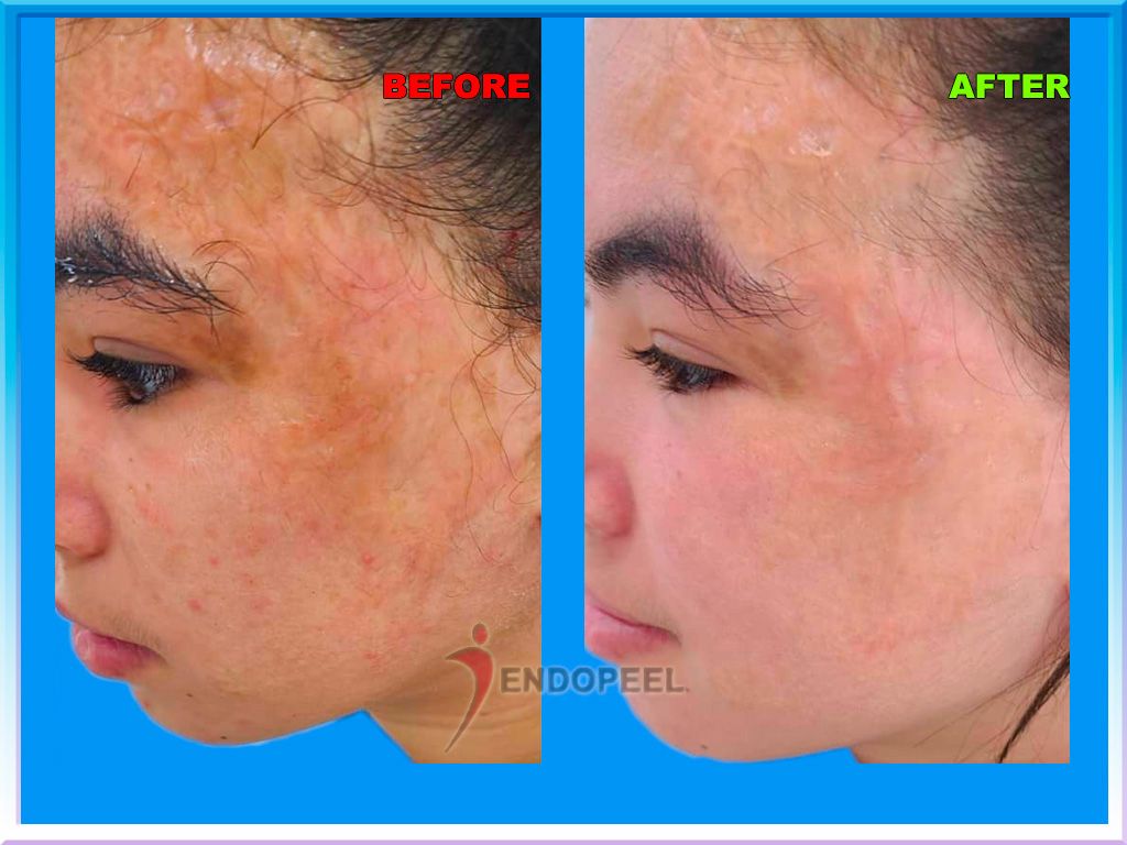 sequelae-of-burns-treated-with-endopeel