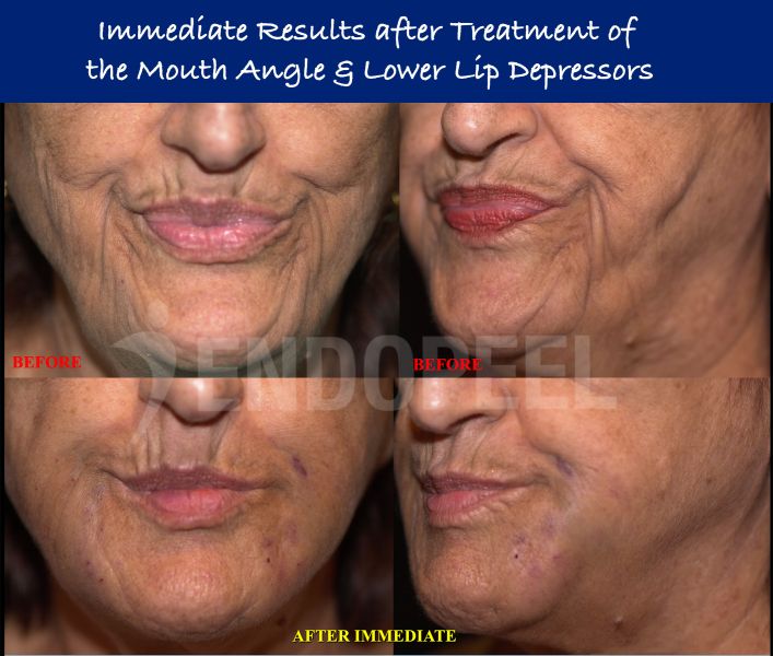 lower-lip-depressors-results-1