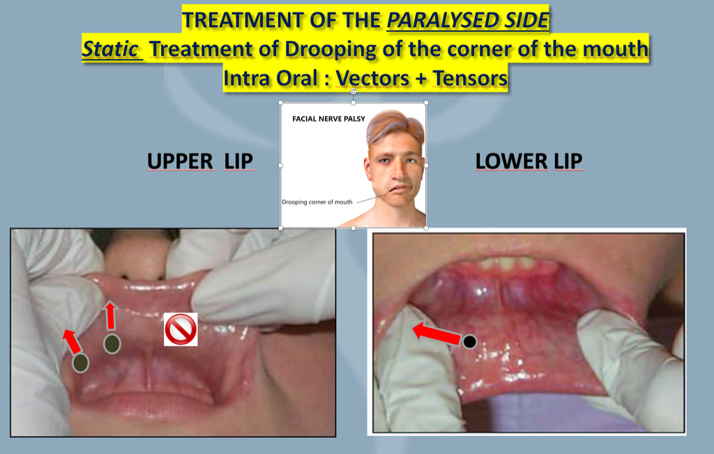 STATIC INTRA ORAL VECTORS AND TENSORS