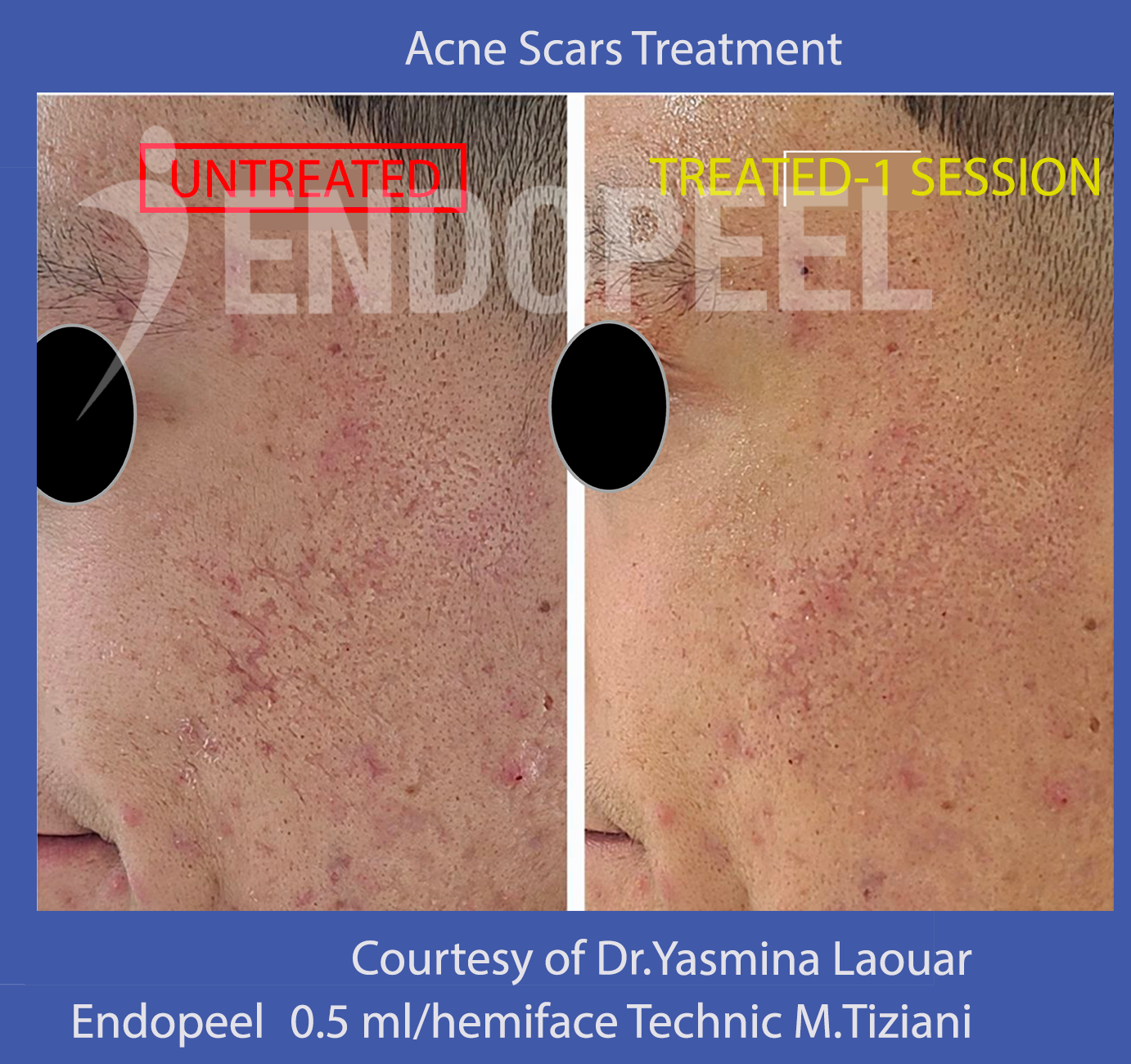 acne scars yasmina left side