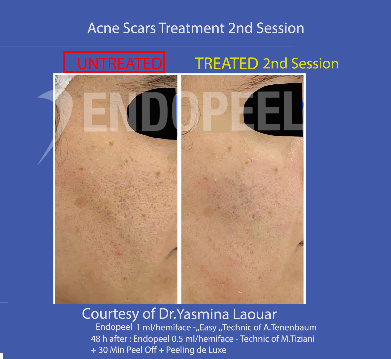 acne scars yasmina 2 nd session