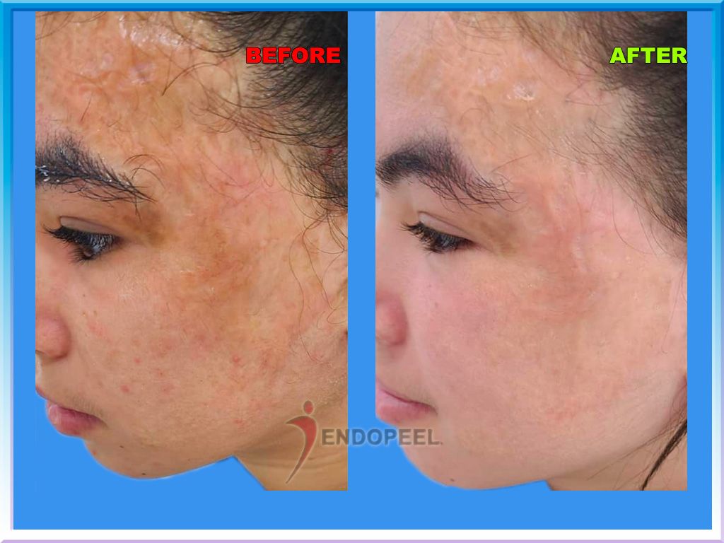 facial sequellae of burns treated with endopeel and peeling de luxe