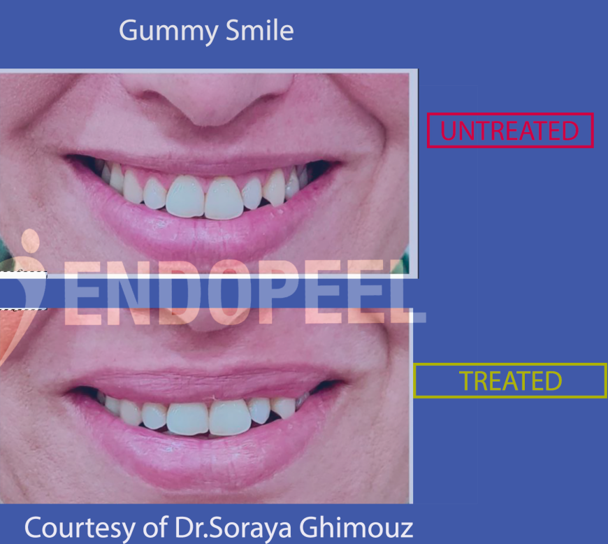 Gummy Smile -Dr.Soraya Ghimouz