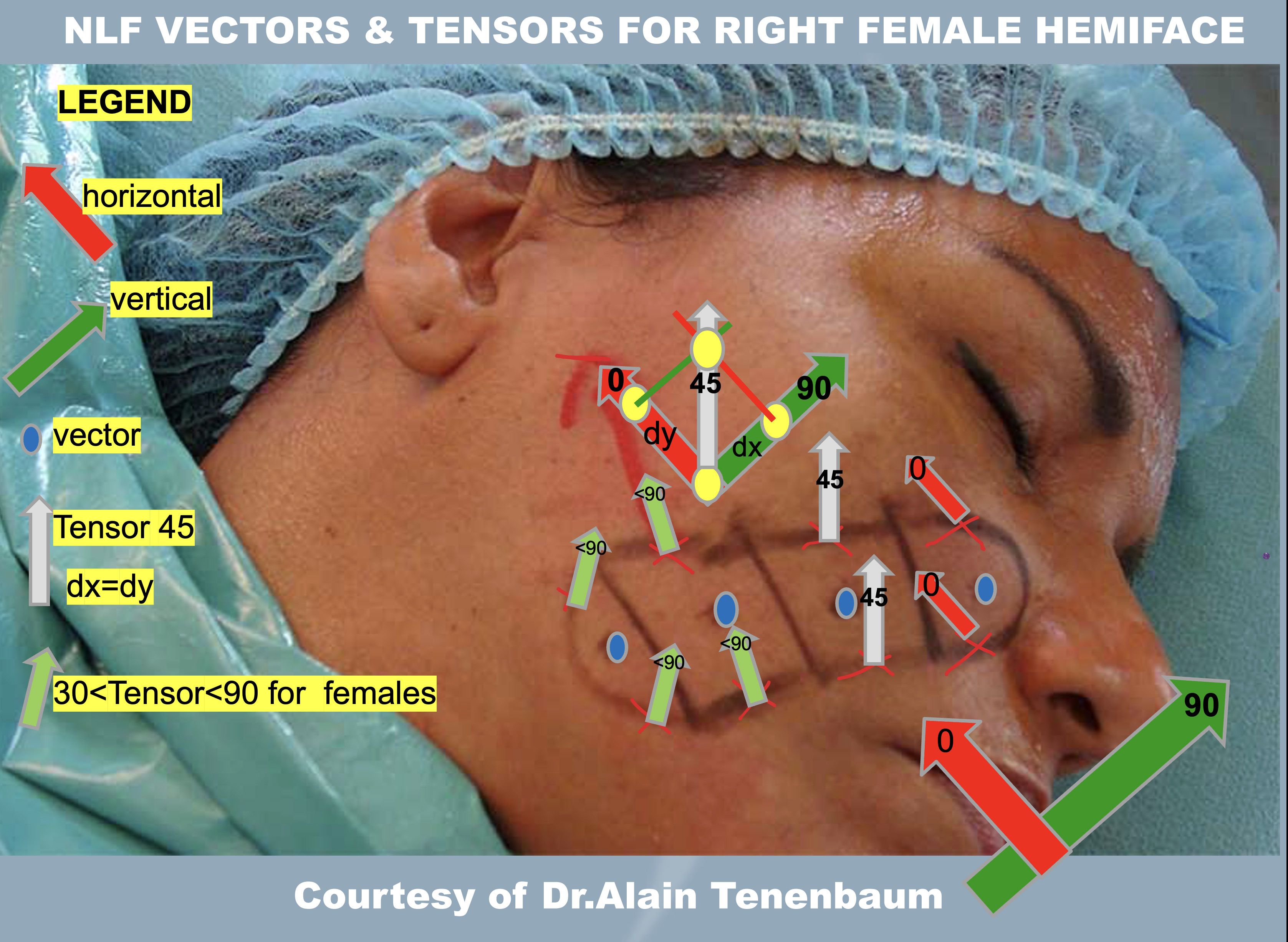 NLF VECTORS-TENSORS-FOR R-FEMALE-HEMIFACE