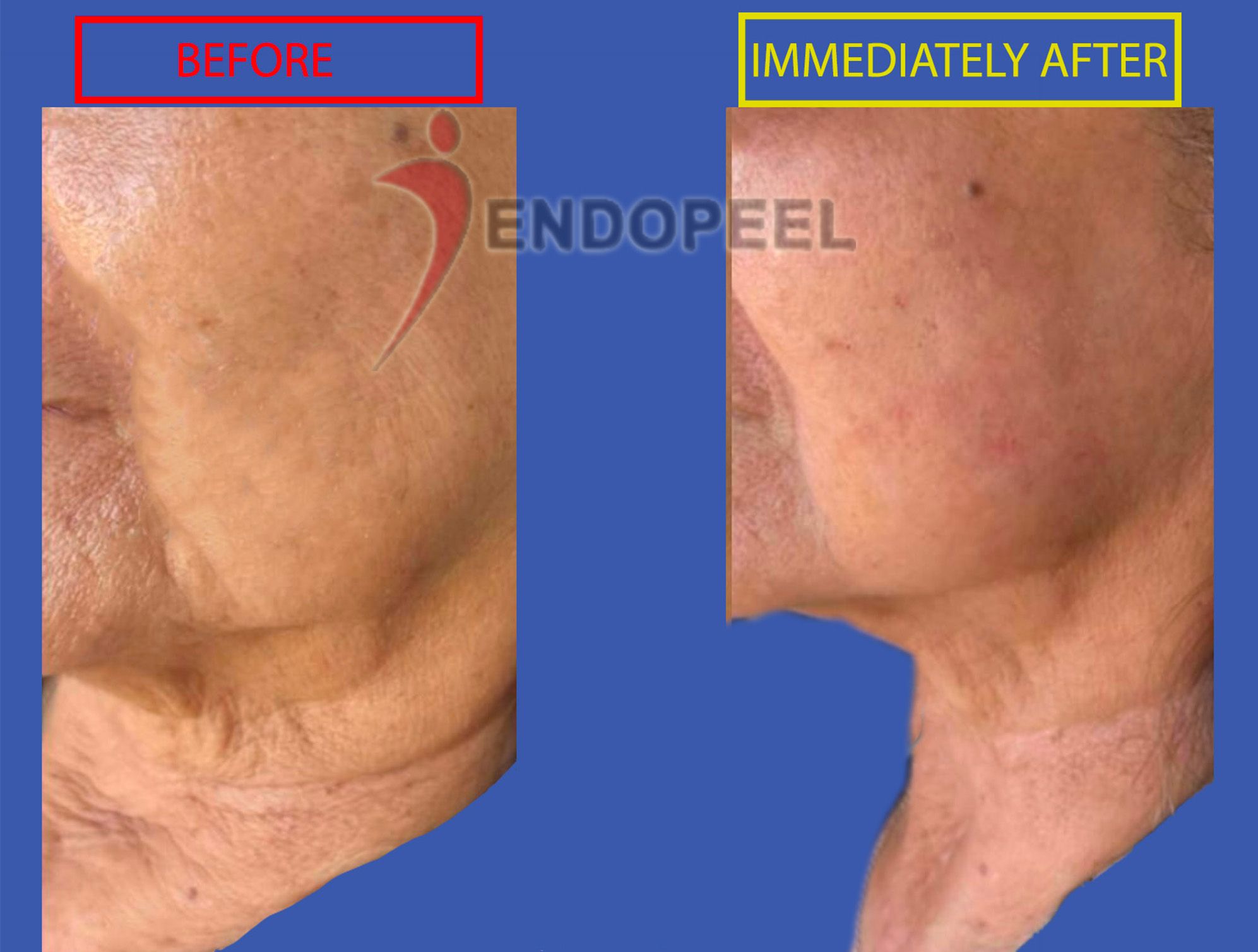 neck-treatment-endopeel