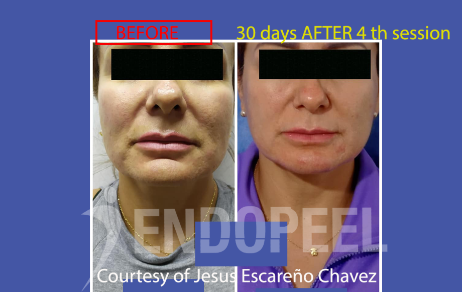 endopeel-pic1-dr.jesus escanero chavez
