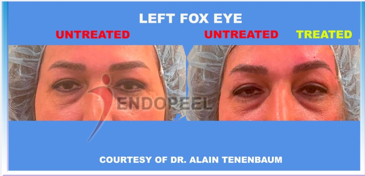average female left fox eye