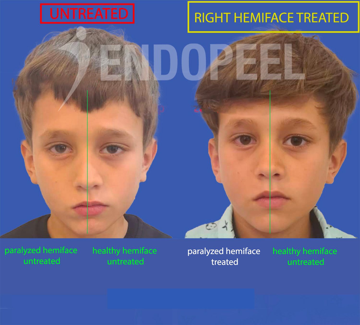 PF-child-endopeel-without-mimicry-nosmile