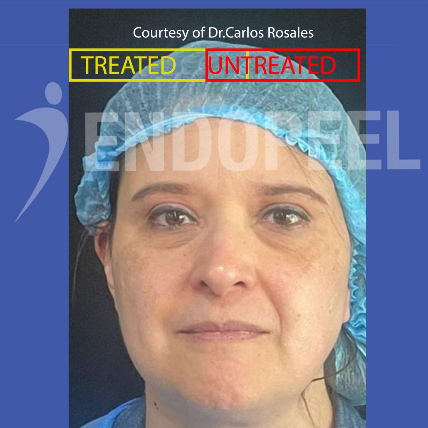 endopeel face treatment by Dr.Carlos Rosales in 2023