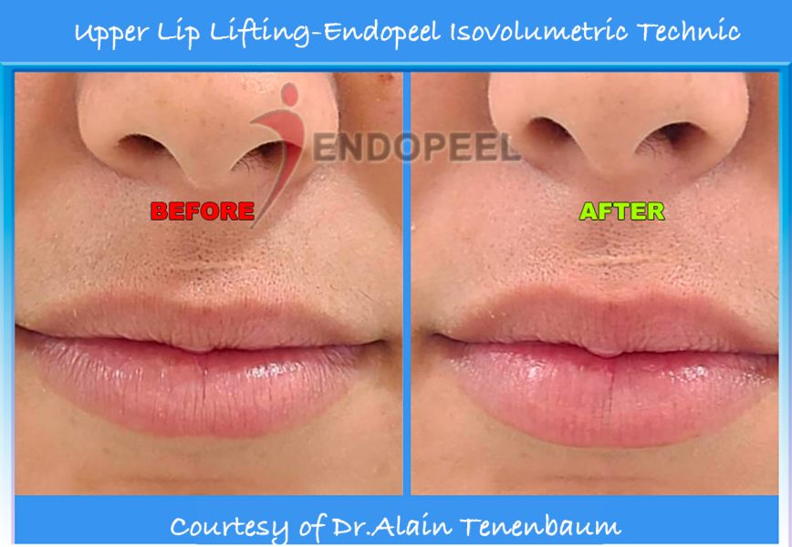 upper lift lifting endopeel