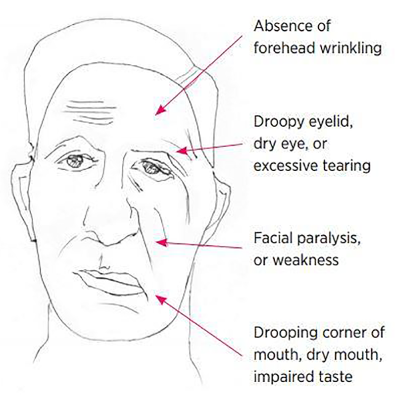 Sequellae of Facial Paralysis